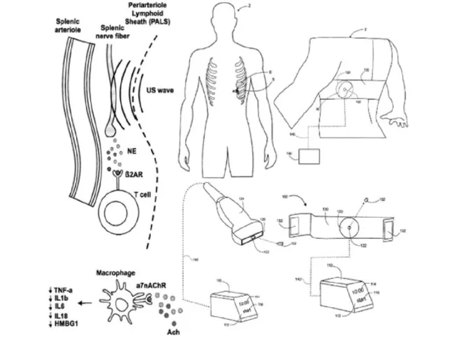 acoustic wave therapy